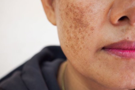 Different Types Of Hyperpigmentation